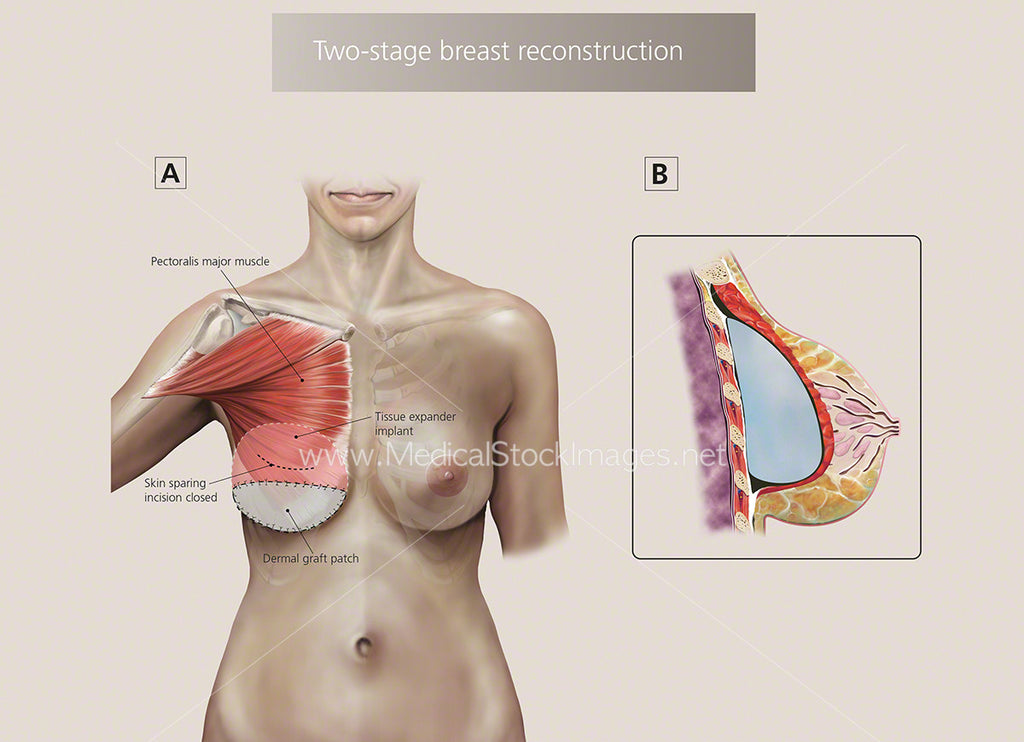 Illustration of Two Stages of Breast Reconstruction – Medical