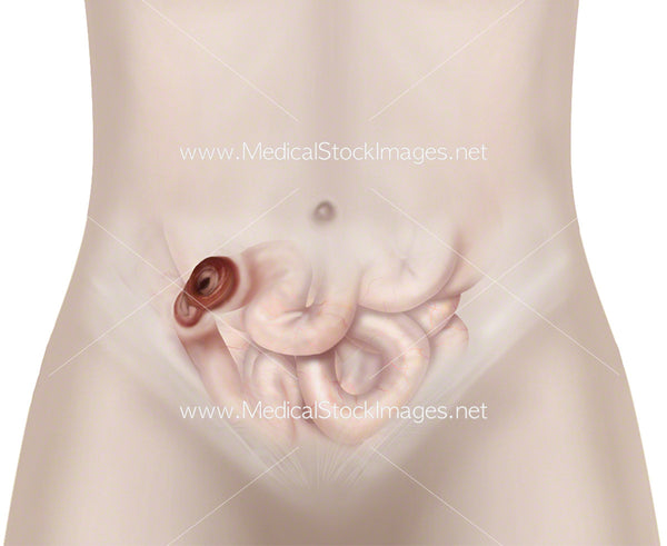 Loop Ileostomy Surgery Medical Stock Images Company