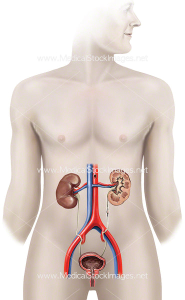 kidney stone in ureter icd 10